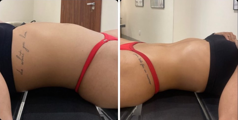 Paciente antes e depois da drenagem linfática, com redução da retenção