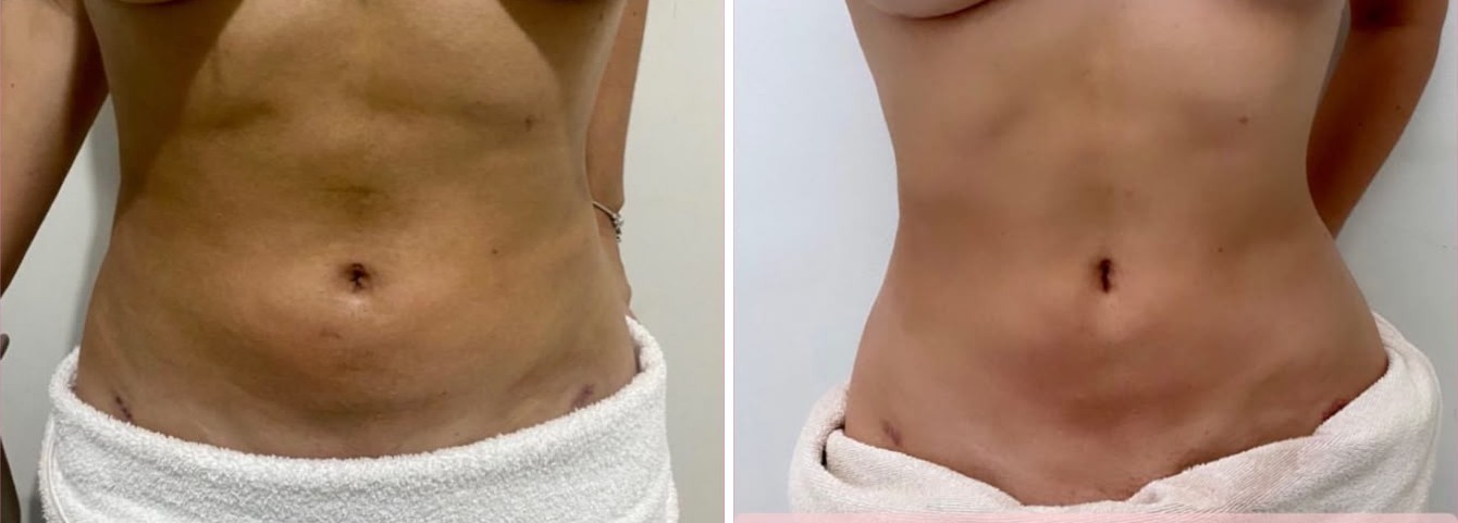 Abdômen de paciente antes e depois da drenagem linfática pós-lipoaspiração