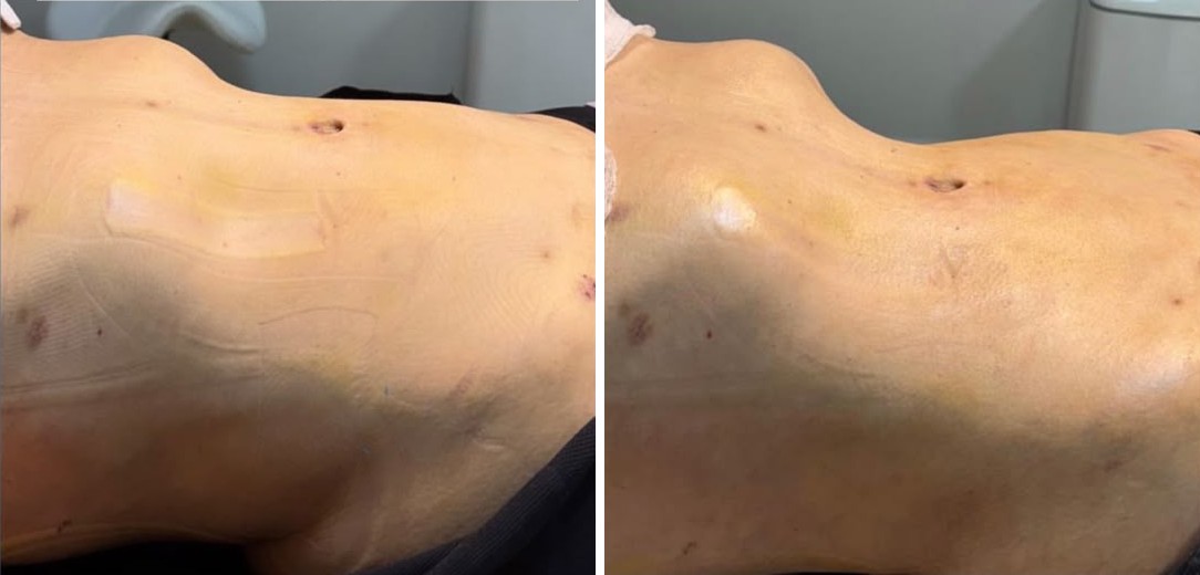 Antes e depois de uma sessão de drenagem linfática no pós-operatório