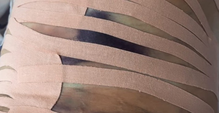 Taping aplicado no pós-operatório de lipoaspiração